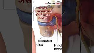 ‘डिस्क’चं आरोग्य कसं बिघडतं जाणून घ्या तज्ज्ञांकडून  Slipped Disc  Health [upl. by Yrehc294]