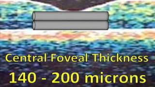 What is Macular Edema  Aftereffects of a CRVO [upl. by Jewell]