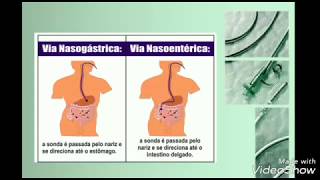 Passagem de SNE Sonda Nasoenteral  Sondagem Nasoenterica [upl. by Anaeirb408]