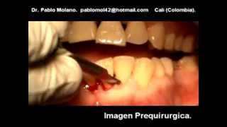 CIRUGIA PERIODONTAL A CAMPO ABIERTO CON TECNICA DE KIRKLAND [upl. by Rochella344]