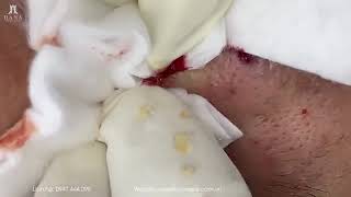 Big Cystic Acne Blackheads Extraction Blackheads amp Milia Whiteheads Removal Pimple Popping 2 [upl. by Yrelle622]