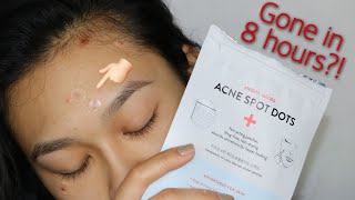 ACNE GONE OVERNIGHT Acne Spot Dot Review [upl. by Yduj]