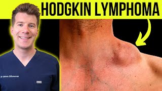 Doctor explains WARNING SYMPTOMS and SIGNS of HODGKINS LYMPHOMA CANCER [upl. by Abelard850]