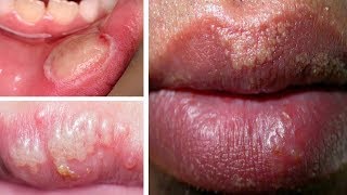 How to Get Rid of Fordyce Spots on Lips Overnight  6 Home Remedies for Fordyce Spots on Lips [upl. by Imekawulo392]