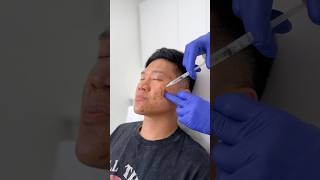 Injections and lasers for my acne scars [upl. by Vanna790]