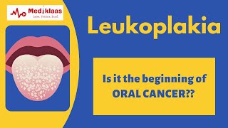 Leukoplakia l Precancerous lesions l Oral pathology l Mediklaas [upl. by Aerdnac401]