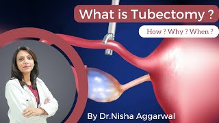 What Is Tubectomy  By DrNisha Aggarwal  How  Why  When   Female Sterilisation [upl. by Anayt919]