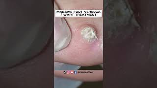 PATIENT MIGHT USING BAZUKA MASSIVE FOOT VERRUCA  WART TREATMENT BY PODIATRIST MISS FOOT FIXER [upl. by Haye450]