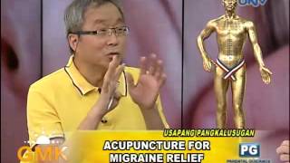 Acupuncture for Migraine relief [upl. by Tremain951]