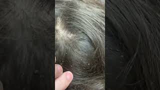 Picking a thousand of lice on hair How to get rid of lice licetok nits piojos kuto kutu lice [upl. by Sioux]