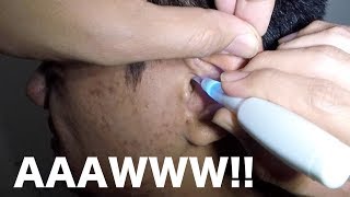 Young Mans Earwax Irrigation amp Extraction [upl. by Miriam282]