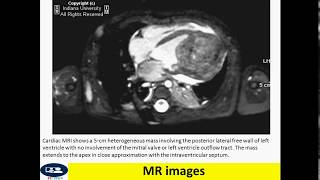 Cardiac fibroma fibroma [upl. by Sucerdor440]