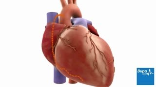 How coronary artery bypass graft CABG surgery is carried out  Bupa Health [upl. by Lizned273]