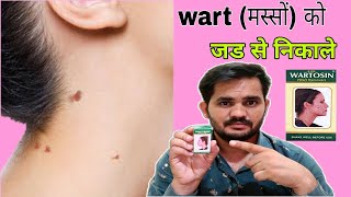 wartosin wart removerमस्सों को हटाए सिर्फ एक दिन मेंwartosin use in hindi [upl. by Atsirk]