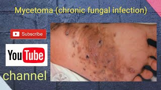 Mycetoma chronic fungal infection [upl. by Norling309]