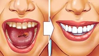 9 Natural Ways to Remove Plaque amp Tartar Buildup  Say Goodbye to Dental Problems [upl. by Oinimreh]