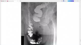 OMENTUM MESENTERY IMAGING EXAM CASES GIT MAYO CLINIC [upl. by Kellyn]