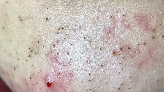 Acne Treatment Huong Da Nang The video has been lost for a long time Remove Blackheads [upl. by Anilas797]