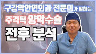 구강악안면외과 전문의s 주걱턱 양악수술 전후로 분석하기 ㅣ 줌구강악안면외과 [upl. by Linell]