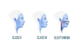 Orthognathic Surgery Explained [upl. by Yrailih]