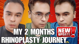 MY 2 MONTHS RHINOPLASTY JOURNEY by Doc Lacson of Kosmed From Day One to 2 Months [upl. by Wertz56]