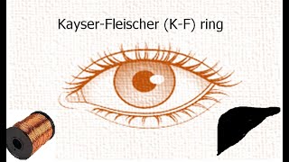 Kayser–Fleischer ring in Wilsons disease by Dr SCL Chandravanshi [upl. by Ahsela]