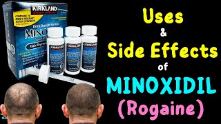 Minoxidil for Hair Loss Treatment  Minoxidil for Hair Growth  Rogaine [upl. by Romulus]