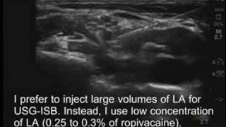 UltrasoundGuided Interscalene Brachial Plexus Block [upl. by Kcerred]