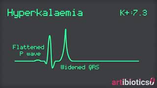 diagnosis of Hyperkalemia in ECG [upl. by Aidnis236]