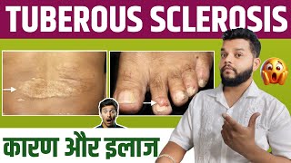 Tuberous Sclerosis Causes Symptoms amp Treatment In Hindi [upl. by Maddocks504]