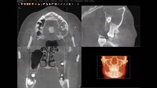 Odontogenic keratocyst OKC  KOT confirmed [upl. by Grace]