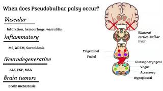 Bulbar vs pseudobulbar palsy [upl. by Aiekahs]