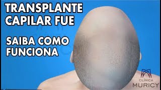 TRANSPLANTE CAPILAR FUE  SAIBA COMO FUNCIONA [upl. by Etiuqram547]