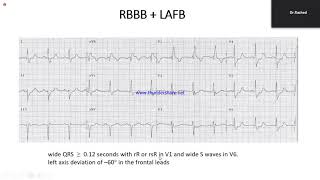 Intraventricular Conduction Defect [upl. by Eelyk6]