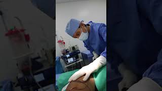 brachioplasty armliposuction armlift [upl. by Dorelle872]