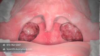 3D Medical Illustration of Tonsils  Tonsillitis Animation  ENT Animation [upl. by Anaizit]