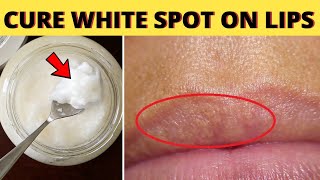 This remedy will naturally cure white spots on lips fast and effectively [upl. by Anetta727]