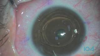 Cirurgia para correção de Alta Miopia com Implante de Lentes Fácicas Artiflex [upl. by Enyahc883]