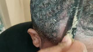 The Best of the Itchy of Scalp Dandruff Compilation Pt 6 [upl. by Darsey]