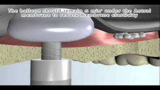 Balloon sinus lift for elevation of the Sinus floor membrane [upl. by Goldie269]