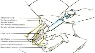 Best location to deliver anaesthetic to perform pudendal nerve block [upl. by Nace]