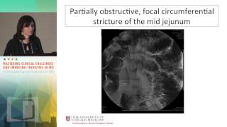 CASE DISCUSSION Upper GI Crohn’s disease with obstruction [upl. by Milla578]