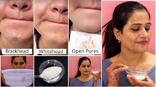 Blackhead पिगमेंटेशन Whitehead व दाग धब्बे हटाने का रामबाण इलाज Get spotless amp Glowing Skin fast [upl. by Stoller995]