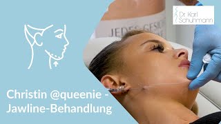 Jawline  Behandlung  Kinnlinie unterspritzen [upl. by Eceinal]