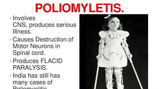 Polio Epidemiology [upl. by Kcorb]