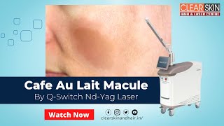 Cafe Au Lait Macule Treatment  Which is the best Laser Treatment for café au lait spots [upl. by Sleinad442]