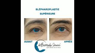 Blepharoplastie supérieure [upl. by Ainiger]