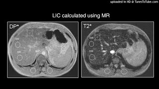 Cardiac and Hepatic Hemosiderosis as Measured by T2MRI [upl. by Nesnej]