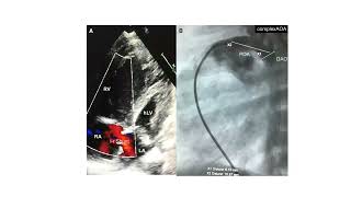 Intervención percutanea Univentricular [upl. by Enileuqcaj]