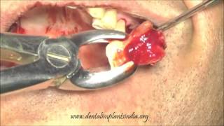 Distal maxillary dental implantation with one piece dental implants [upl. by Suirtemid]